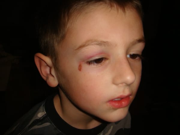 Looks like a black eye....